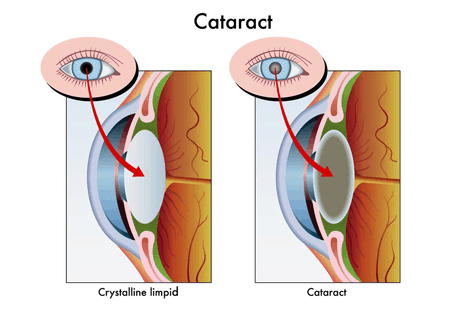Cataract450