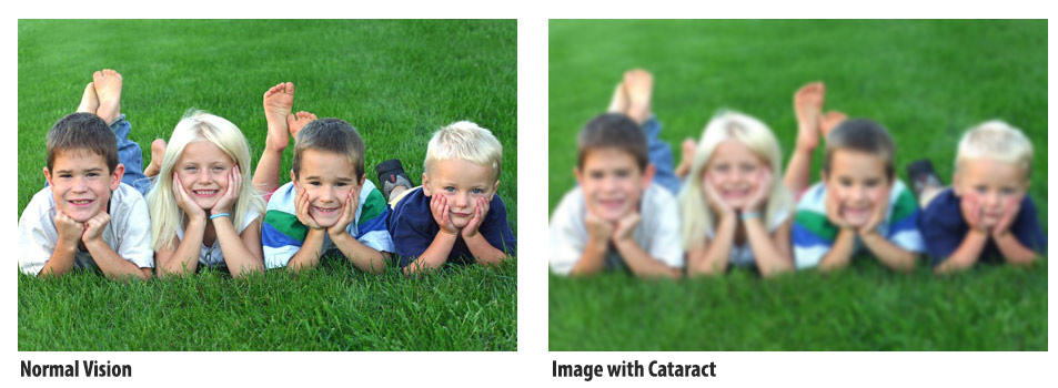 cataract-comparision
