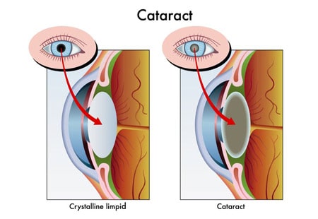cataract