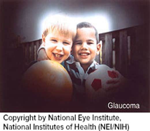 glaucoma-yes
